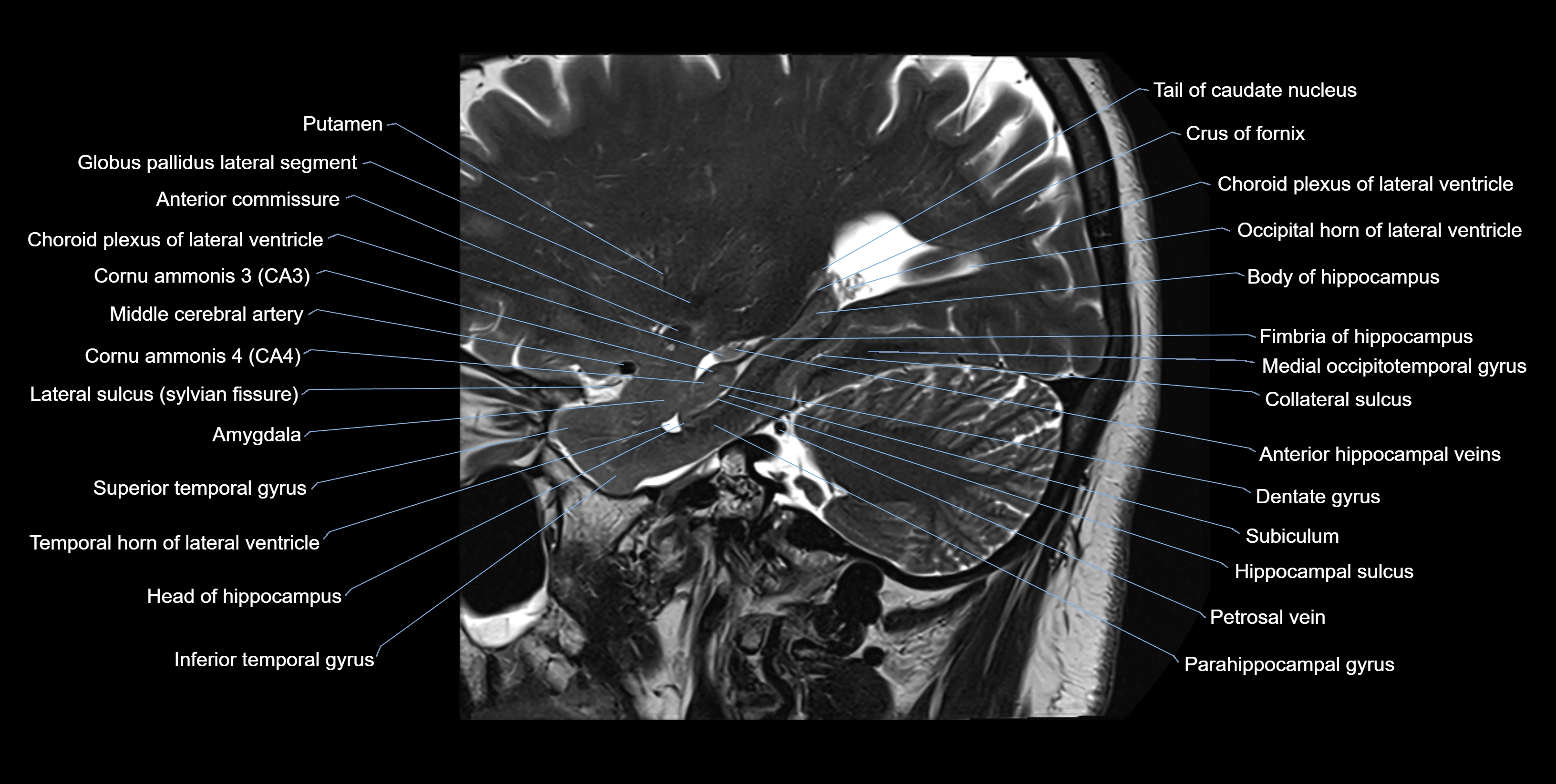 hippocampus sagittal cross sectional anatomy 3T MRI images -img-10006.webp